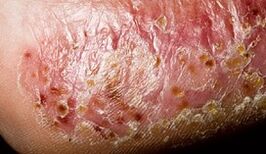 Dermatomykóza