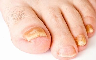 Foto příznaky nehtových houby