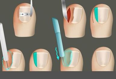 Odstranění hřebíku v přítomnosti houby na nohou