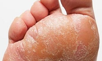 Příznaky a příznaky houby na nohou